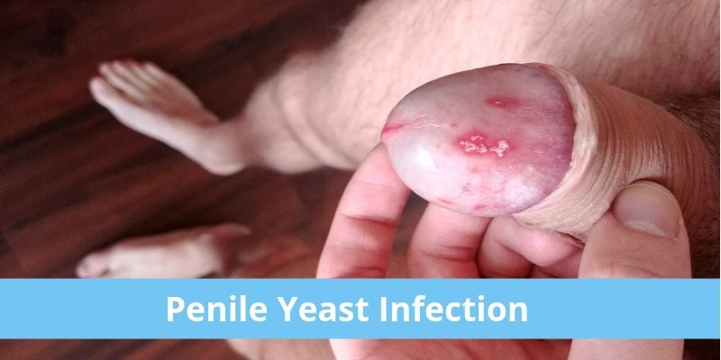 Causes for Penile Yeast Infection