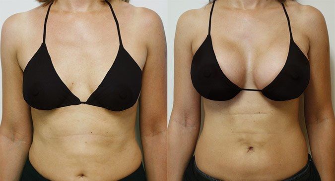 before and after breast size 